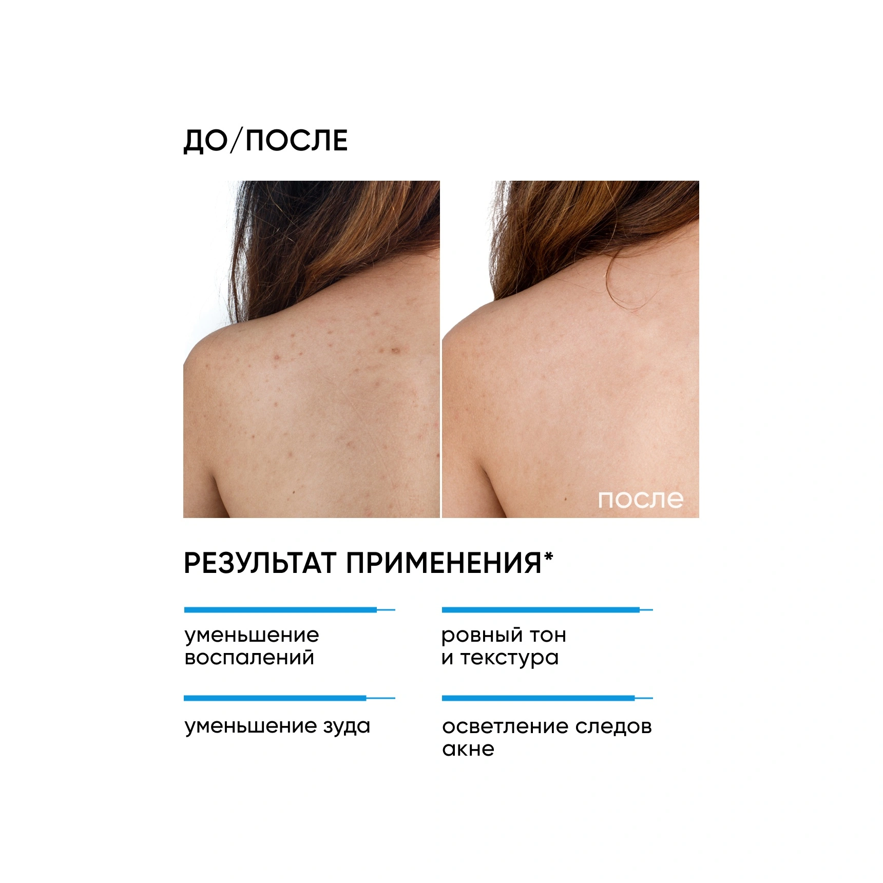 Сыворотка-спрей Acne Free Solution  купить в VISAGEHALL